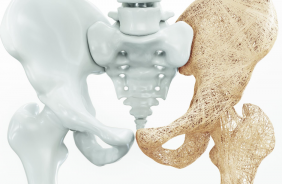 Osteoporose e exerc�cio f�sico